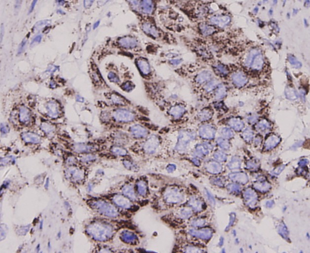Immunohistochemical analysis of paraffin-embedded human stomach cancer tissue using anti-EGFR antibody. The section was pre-treated using heat mediated antigen retrieval with Tris-EDTA buffer (pH 8.0-8.4) for 20 minutes.The tissues were blocked in 5% BSA for 30 minutes at room temperature, washed with ddH<sub>2</sub>O and PBS, and then probed with the antibody (<a href="/products/0407-21" style="font-weight: bold;text-decoration: underline;">0407-21</a>) at 1/200 dilution, for 30 minutes at room temperature and detected using an HRP conjugated compact polymer system. DAB was used as the chrogen. Counter stained with hematoxylin and mounted with DPX.