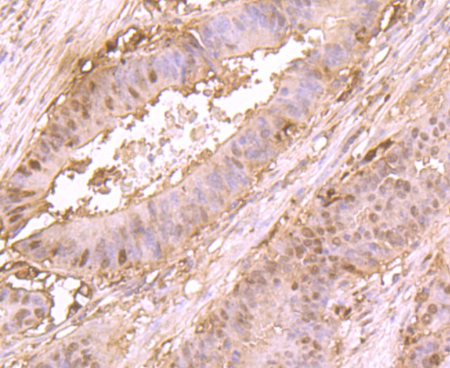 Immunohistochemical analysis of paraffin-embedded human colon cancer tissue using anti-L-FABP antibody. Counter stained with hematoxylin.