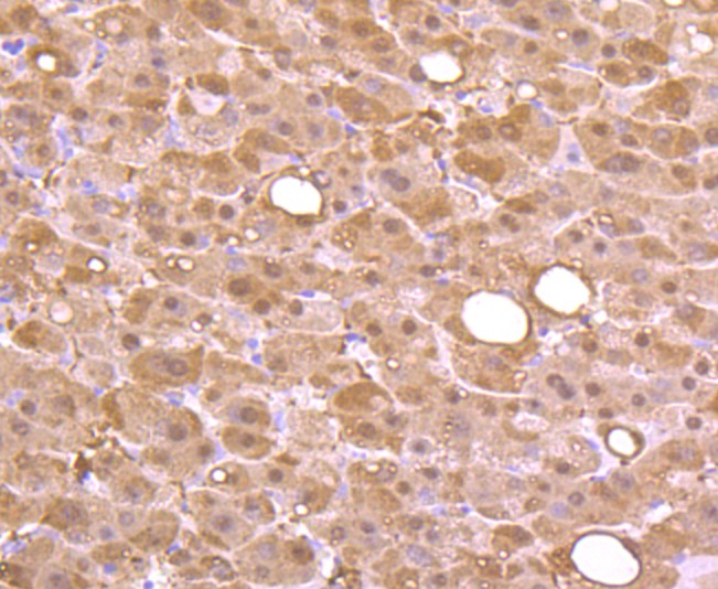 Immunohistochemical analysis of paraffin-embedded human liver cancer tissue using anti-L-FABP antibody. Counter stained with hematoxylin.