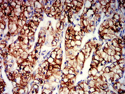 Immunohistochemical analysis of paraffin-embedded human renal cancer tissue using anti-CD203C antibody. The section was pre-treated using heat mediated antigen retrieval with Tris-EDTA buffer (pH 8.0) for 20 minutes. The tissues were blocked in 5% BSA for 30 minutes at room temperature, washed with ddH<sub>2</sub>O and PBS, and then probed with the primary antibody (<a href="/products/EM1710-93" style="font-weight: bold;text-decoration: underline;">EM1710-93</a>, 1/100) for 30 minutes at room temperature. The detection was performed using an HRP conjugated compact polymer system. DAB was used as the chromogen. Tissues were counterstained with hematoxylin and mounted with DPX.
