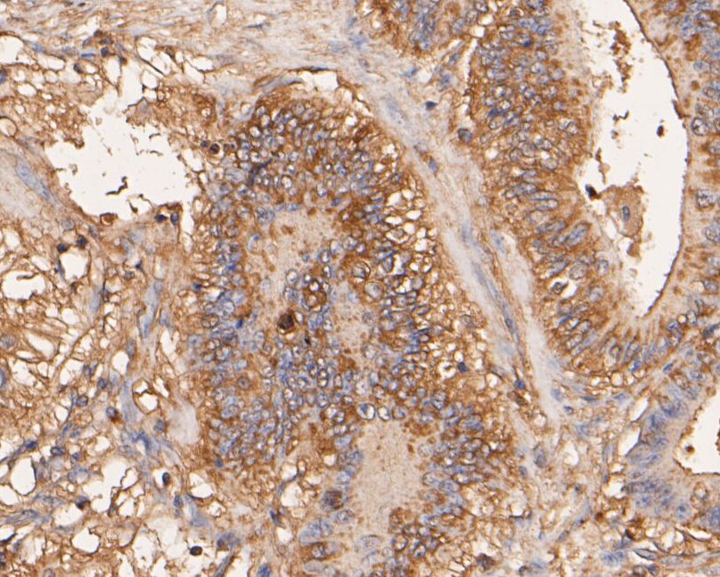 Immunohistochemical analysis of paraffin-embedded human colon carcinoma tissue using anti-Aspartate Aminotransferase antibody. The section was pre-treated using heat mediated antigen retrieval with Tris-EDTA buffer (pH 8.0-8.4) for 20 minutes.The tissues were blocked in 5% BSA for 30 minutes at room temperature, washed with ddH<sub>2</sub>O and PBS, and then probed with the primary antibody (<a href="/products/EM1901-50" style="font-weight: bold;text-decoration: underline;">EM1901-50</a>, 1/200) for 30 minutes at room temperature. The detection was performed using an HRP conjugated compact polymer system. DAB was used as the chromogen. Tissues were counterstained with hematoxylin and mounted with DPX.