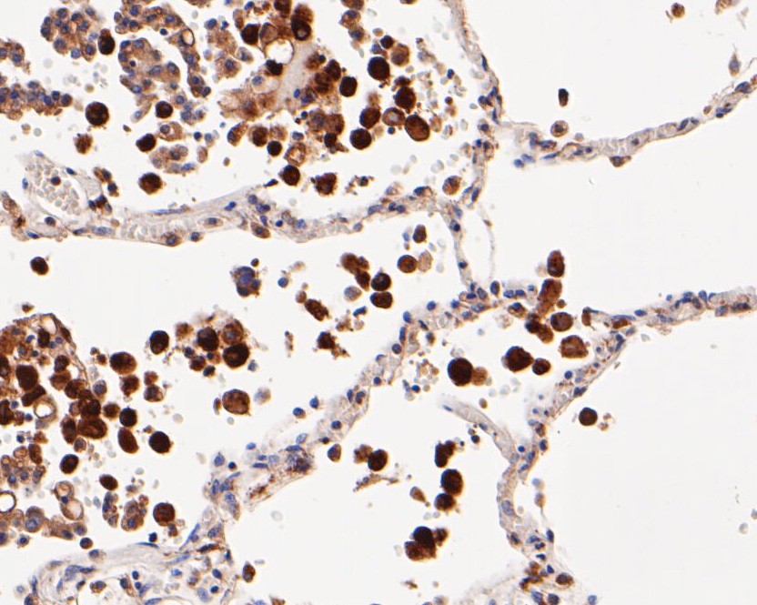 Immunohistochemical analysis of paraffin-embedded human lung tissue using anti-CD68 antibody. The section was pre-treated using heat mediated antigen retrieval with Tris-EDTA buffer (pH 8.0-8.4) for 20 minutes.The tissues were blocked in 5% BSA for 30 minutes at room temperature, washed with ddH<sub>2</sub>O and PBS, and then probed with the primary antibody (<a href="/products/EM1901-95" style="font-weight: bold;text-decoration: underline;">EM1901-95</a>, 1/200) for 30 minutes at room temperature. The detection was performed using an HRP conjugated compact polymer system. DAB was used as the chromogen. Tissues were counterstained with hematoxylin and mounted with DPX.