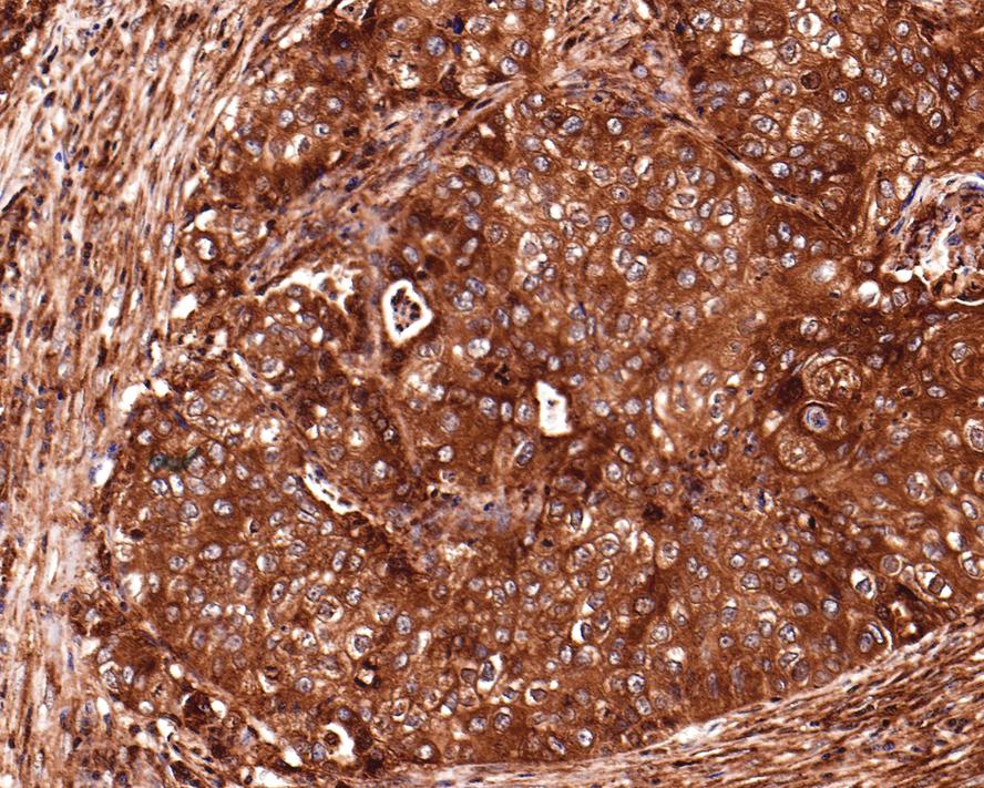 Immunohistochemical analysis of paraffin-embedded human lung tissue with Rabbit anti-NF-κB p65 antibody (<a href="/products/ET1603-12" style="font-weight: bold;text-decoration: underline;">ET1603-12</a>) at 1/200 dilution.<br /><br />The section was pre-treated using heat mediated antigen retrieval with sodium citrate buffer (pH 6.0) for 2 minutes. The tissues were blocked in 1% BSA for 20 minutes at room temperature, washed with ddH<sub>2</sub>O and PBS, and then probed with the primary antibody (<a href="/products/ET1603-12" style="font-weight: bold;text-decoration: underline;">ET1603-12</a>) at 1/200 dilution for 1 hour at room temperature. The detection was performed using an HRP conjugated compact polymer system. DAB was used as the chromogen. Tissues were counterstained with hematoxylin and mounted with DPX.