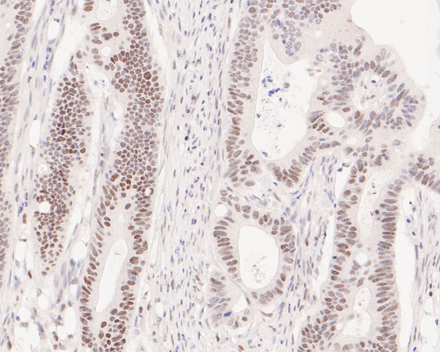 Immunohistochemical analysis of paraffin-embedded human colon carcinoma tissue using anti-PMS2 antibody. The section was pre-treated using heat mediated antigen retrieval with sodium citrate buffer (pH 6.0) for 20 minutes. The tissues were blocked in 5% BSA for 30 minutes at room temperature, washed with ddH<sub>2</sub>O and PBS, and then probed with the primary antibody (<a href="/products/ET1605-1" style="font-weight: bold;text-decoration: underline;">ET1605-1</a>, 1/200)  for 30 minutes at room temperature. The detection was performed using an HRP conjugated compact polymer system. DAB was used as the chromogen. Tissues were counterstained with hematoxylin and mounted with DPX.