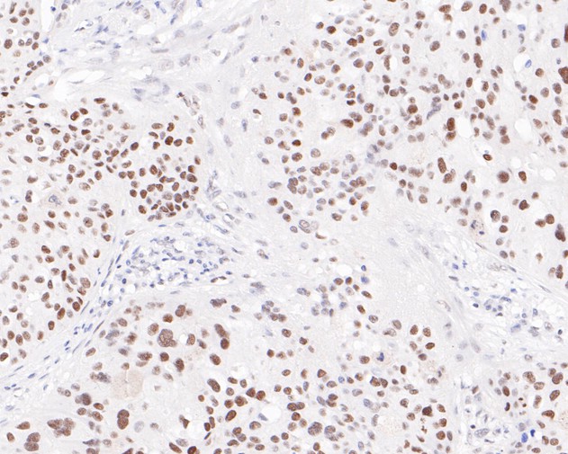 Immunohistochemical analysis of paraffin-embedded human breast carcinoma tissue using anti-PMS2 antibody. The section was pre-treated using heat mediated antigen retrieval with sodium citrate buffer (pH 6.0) for 20 minutes. The tissues were blocked in 5% BSA for 30 minutes at room temperature, washed with ddH<sub>2</sub>O and PBS, and then probed with the primary antibody (<a href="/products/ET1605-1" style="font-weight: bold;text-decoration: underline;">ET1605-1</a>, 1/200)  for 30 minutes at room temperature. The detection was performed using an HRP conjugated compact polymer system. DAB was used as the chromogen. Tissues were counterstained with hematoxylin and mounted with DPX.