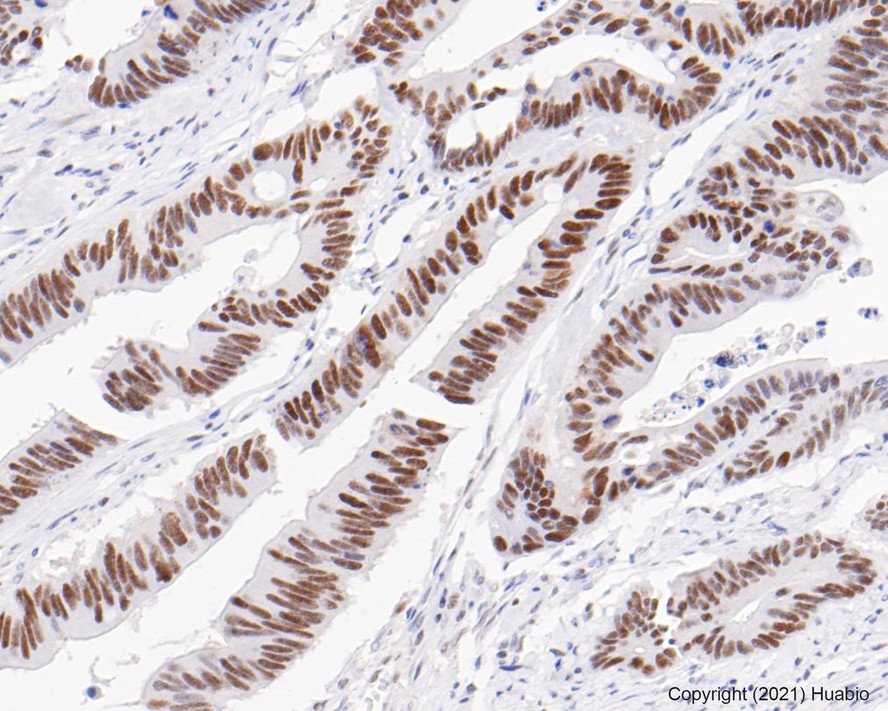 Immunohistochemical analysis of paraffin-embedded human colon carcinoma tissue using anti-PMS2 antibody. The section was pre-treated using heat mediated antigen retrieval with sodium citrate buffer (pH 6.0) for 20 minutes. The tissues were blocked in 5% BSA for 30 minutes at room temperature, washed with ddH<sub>2</sub>O and PBS, and then probed with the primary antibody (<a href="/products/ET1605-1" style="font-weight: bold;text-decoration: underline;">ET1605-1</a>, 1/50)  for 30 minutes at room temperature. The detection was performed using an HRP conjugated compact polymer system. DAB was used as the chromogen. Tissues were counterstained with hematoxylin and mounted with DPX.