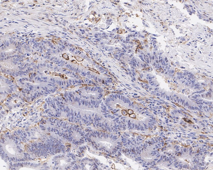 Immunohistochemical analysis of paraffin-embedded human colon cancer tissue with Rabbit anti-CD11c antibody (<a href="/products/ET1606-19" style="font-weight: bold;text-decoration: underline;">ET1606-19</a>) at 1/800 dilution.<br /><br />The section was pre-treated using heat mediated antigen retrieval with Tris-EDTA buffer (pH 9.0) for 20 minutes. The tissues were blocked in 1% BSA for 20 minutes at room temperature, washed with ddH<sub>2</sub>O and PBS, and then probed with the primary antibody (<a href="/products/ET1606-19" style="font-weight: bold;text-decoration: underline;">ET1606-19</a>) at 1/800 dilution for 1 hour at room temperature. The detection was performed using an HRP conjugated compact polymer system. DAB was used as the chromogen. Tissues were counterstained with hematoxylin and mounted with DPX.