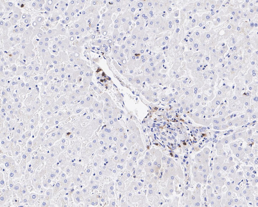 Immunohistochemical analysis of paraffin-embedded human liver tissue with Rabbit anti-CD11c antibody (<a href="/products/ET1606-19" style="font-weight: bold;text-decoration: underline;">ET1606-19</a>) at 1/800 dilution.<br /><br />The section was pre-treated using heat mediated antigen retrieval with Tris-EDTA buffer (pH 9.0) for 20 minutes. The tissues were blocked in 1% BSA for 20 minutes at room temperature, washed with ddH<sub>2</sub>O and PBS, and then probed with the primary antibody (<a href="/products/ET1606-19" style="font-weight: bold;text-decoration: underline;">ET1606-19</a>) at 1/800 dilution for 1 hour at room temperature. The detection was performed using an HRP conjugated compact polymer system. DAB was used as the chromogen. Tissues were counterstained with hematoxylin and mounted with DPX.