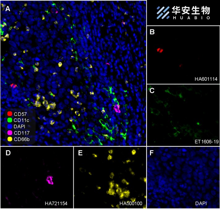 Fluorescence multiplex immunohistochemical analysis of the human cervical cancer (Formalin/PFA-fixed paraffin-embedded sections). Panel A: the merged image of anti-CD57 (<a href="/products/HA601114" style="font-weight: bold;text-decoration: underline;">HA601114</a>, red), anti-CD11c (<a href="/products/ET1606-19" style="font-weight: bold;text-decoration: underline;">ET1606-19</a>, green), anti-CD117 (HA21154, magenta) and anti-CD66b (<a href="/products/HA500100" style="font-weight: bold;text-decoration: underline;">HA500100</a>, yellow) on human cervical cancer. Panel B: anti- CD57 stained on NKT cells. Panel C: anti-CD11c stained on dendritic cells. Panel D: anti-CD117 stained on mast cells. Panel E: anti-CD66b stained on neutrophils. HRP Conjugated UltraPolymer Goat Polyclonal Antibody HA1119/HA1120 was used as a secondary antibody. The immunostaining was performed with the Sequential Immuno-staining Kit (IRISKit&trade;MH010101, www.luminiris.cn). The section was incubated in four rounds of staining: in the order of <a href="/products/HA601114" style="font-weight: bold;text-decoration: underline;">HA601114</a> (1/500 dilution), <a href="/products/ET1606-19" style="font-weight: bold;text-decoration: underline;">ET1606-19</a> (1/1,000 dilution), <a href="/products/HA721154" style="font-weight: bold;text-decoration: underline;">HA721154</a> (1/1,000 dilution), and <a href="/products/HA500100" style="font-weight: bold;text-decoration: underline;">HA500100</a> (1/1,000 dilution) for 20 mins at room temperature. Each round was followed by a separate fluorescent tyramide signal amplification system. Heat mediated antigen retrieval with Tris-EDTA buffer (pH 9.0) for 30 mins at 95C. DAPI (blue) was used as a nuclear counter stain. Image acquisition was performed with Olympus VS200 Slide Scanner.