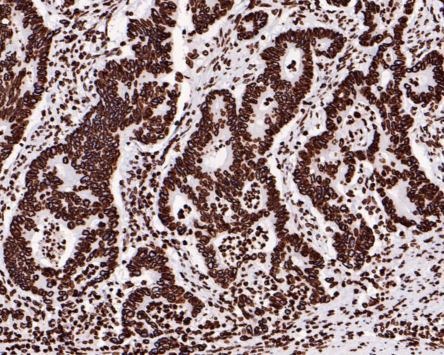 Immunohistochemical analysis of paraffin-embedded human colon carcinoma tissue with Rabbit anti-Lamin B1 antibody (<a href="/products/ET1606-27" style="font-weight: bold;text-decoration: underline;">ET1606-27</a>) at 1/500 dilution.<br /><br />The section was pre-treated using heat mediated antigen retrieval with sodium citrate buffer (pH 6.0) for 2 minutes. The tissues were blocked in 1% BSA for 20 minutes at room temperature, washed with ddH<sub>2</sub>O and PBS, and then probed with the primary antibody (<a href="/products/ET1606-27" style="font-weight: bold;text-decoration: underline;">ET1606-27</a>) at 1/500 dilution for 1 hour at room temperature. The detection was performed using an HRP conjugated compact polymer system. DAB was used as the chromogen. Tissues were counterstained with hematoxylin and mounted with DPX.