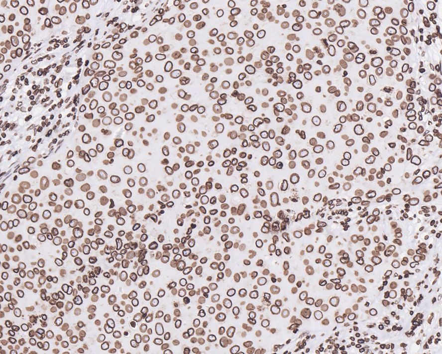 Immunohistochemical analysis of paraffin-embedded human breast carcinoma tissue with Rabbit anti-Lamin B1 antibody (<a href="/products/ET1606-27" style="font-weight: bold;text-decoration: underline;">ET1606-27</a>) at 1/1,000 dilution.<br /><br />The section was pre-treated using heat mediated antigen retrieval with Tris-EDTA buffer (pH 9.0) for 20 minutes. The tissues were blocked in 1% BSA for 20 minutes at room temperature, washed with ddH<sub>2</sub>O and PBS, and then probed with the primary antibody (<a href="/products/ET1606-27" style="font-weight: bold;text-decoration: underline;">ET1606-27</a>) at 1/1,000 dilution for 1 hour at room temperature. The detection was performed using an HRP conjugated compact polymer system. DAB was used as the chromogen. Tissues were counterstained with hematoxylin and mounted with DPX.