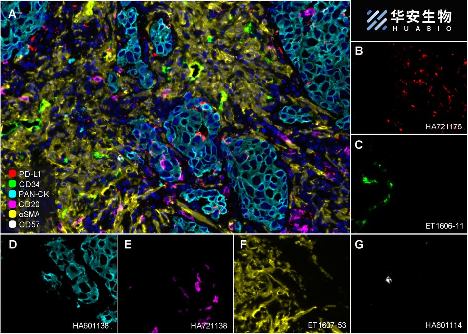 Fluorescence multiplex immunohistochemical analysis of Human non-small cell lung cancer (Formalin/PFA-fixed paraffin-embedded sections). Panel A: the merged image of anti-PD-L1 (<a href="/products/HA721176" style="font-weight: bold;text-decoration: underline;">HA721176</a>, red), anti-CD34 (<a href="/products/ET1606-11" style="font-weight: bold;text-decoration: underline;">ET1606-11</a>, green), anti-Pan-CK (<a href="/products/HA601138" style="font-weight: bold;text-decoration: underline;">HA601138</a>, cyan), anti-CD20 (<a href="/products/HA721138" style="font-weight: bold;text-decoration: underline;">HA721138</a>, magenta), anti-αSMA (<a href="/products/ET1607-53" style="font-weight: bold;text-decoration: underline;">ET1607-53</a>, yellow) and anti-CD57 (<a href="/products/HA601114" style="font-weight: bold;text-decoration: underline;">HA601114</a>, white) on NSCLC. Panel B: anti-PD-L1 stained on dendritic cells and macrophages cells. Panel C: anti- CD34 stained on endothelial cells. Panel D: anti-Pan-CK stained on cancer cells. Panel E: CD20 stained on B cells. Panel F: anti-αSMA stained on cancer-associated fibroblasts and smooth muscle cells. Panel G: anti-CD57 stained on NK cells and T cells. HRP Conjugated UltraPolymer Goat Polyclonal Antibody HA1119/HA1120 was used as a secondary antibody. The immunostaining was performed with the Sequential Immuno-staining Kit (IRISKit&trade;MH010101, www.luminiris.cn). The section was incubated in six rounds of staining: in the order of <a href="/products/HA721176" style="font-weight: bold;text-decoration: underline;">HA721176</a> (1/1,000 dilution), <a href="/products/ET1606-11" style="font-weight: bold;text-decoration: underline;">ET1606-11</a> (1/1,000 dilution), <a href="/products/HA601138" style="font-weight: bold;text-decoration: underline;">HA601138</a> (1/3,000 dilution), <a href="/products/HA721138" style="font-weight: bold;text-decoration: underline;">HA721138</a> (1/2,000 dilution), <a href="/products/ET1607-53" style="font-weight: bold;text-decoration: underline;">ET1607-53</a> (1/3,000 dilution) and <a href="/products/HA601114" style="font-weight: bold;text-decoration: underline;">HA601114</a> (1/1,000 dilution) for 20 mins at room temperature. Each round was followed by a separate fluorescent tyramide signal amplification system. Heat mediated antigen retrieval with Tris-EDTA buffer (pH 9.0) for 30 mins at 95℃. DAPI (blue) was used as a nuclear counter stain. Image acquisition was performed with Olympus VS200 Slide Scanner.
