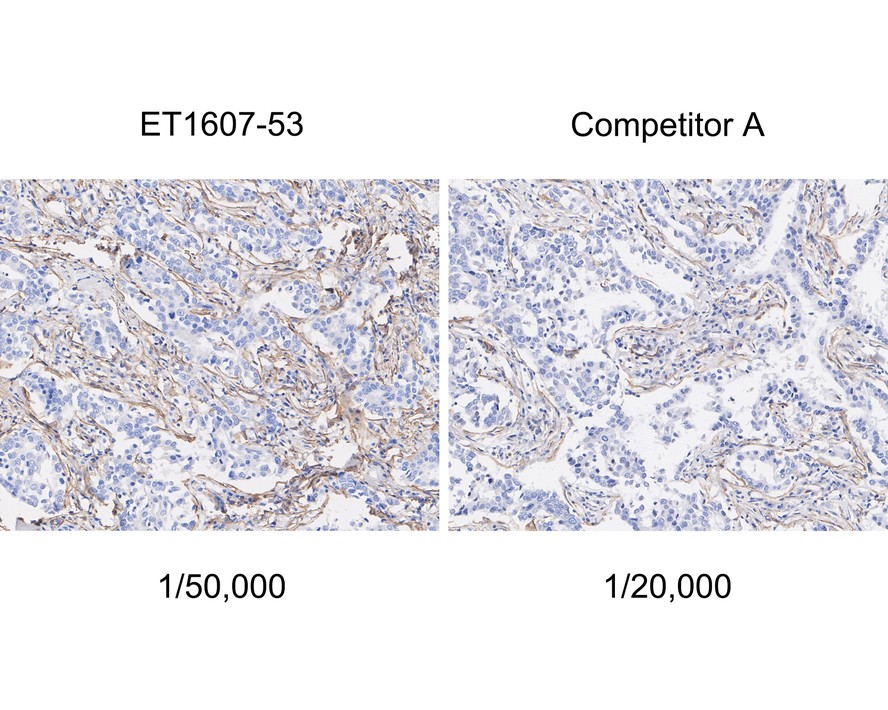 Immunohistochemical analysis of paraffin-embedded human breast carcinoma tissue with Rabbit anti-alpha smooth muscle Actin antibody (<a href="/products/ET1607-53" style="font-weight: bold;text-decoration: underline;">ET1607-53</a>) at 1/50,000 dilution and competitor's antibody at 1/20,000 dilution.<br /><br />The section was pre-treated using heat mediated antigen retrieval with sodium citrate buffer (pH 6.0) for 2 minutes. The tissues were blocked in 1% BSA for 20 minutes at room temperature, washed with ddH<sub>2</sub>O and PBS, and then probed with the primary antibody (<a href="/products/ET1607-53" style="font-weight: bold;text-decoration: underline;">ET1607-53</a>) at 1/50,000 dilution and competitor's antibody at 1/20,000 dilution for 1 hour at room temperature. The detection was performed using an HRP conjugated compact polymer system. DAB was used as the chromogen. Tissues were counterstained with hematoxylin and mounted with DPX.
