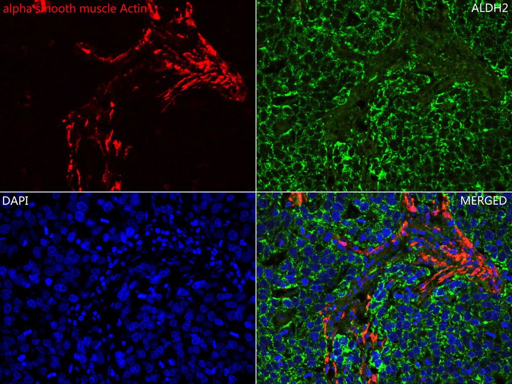 Immunofluorescence analysis of paraffin-embedded human stomach cancer tissue labeling alpha smooth muscle Actin (<a href="/products/ET1607-53" style="font-weight: bold;text-decoration: underline;">ET1607-53</a>) and ALDH2 (M1509-1).<br /><br />The section was pre-treated using heat mediated antigen retrieval with Tris-EDTA buffer (pH 9.0) for 20 minutes. The tissues were blocked in 10% negative goat serum for 1 hour at room temperature, washed with PBS. And then probed with the primary antibody alpha smooth muscle Actin (<a href="/products/ET1607-53" style="font-weight: bold;text-decoration: underline;">ET1607-53</a>, red) at 1/1,000 dilution and ALDH2 (<a href="/products/M1509-1" style="font-weight: bold;text-decoration: underline;">M1509-1</a>, green) at 1/100 dilution overnight at 4 ℃, washed with PBS.<br /><br />iFluor&trade; 488 conjugate-Goat anti-Mouse IgG (<a href="/products/HA1125" style="font-weight: bold;text-decoration: underline;">HA1125</a>) and iFluor&trade; 647 conjugate-Goat anti-Rabbit IgG (<a href="/products/HA1123" style="font-weight: bold;text-decoration: underline;">HA1123</a>) was used as the secondary antibody at 1/1,000 dilution. DAPI was used as nuclear counterstain.