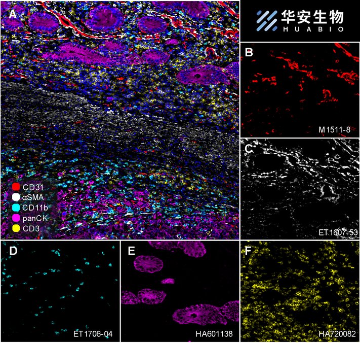 Fluorescence multiplex immunohistochemical analysis of the human gastric cancer (Formalin/PFA-fixed paraffin-embedded sections). Panel A: the merged image of anti-Ki67 (<a href="/products/HA721115" style="font-weight: bold;text-decoration: underline;">HA721115</a>, red), anti-CD31 (<a href="/products/M1511-8" style="font-weight: bold;text-decoration: underline;">M1511-8</a>, green), anti-CD3 (<a href="/products/HA720082" style="font-weight: bold;text-decoration: underline;">HA720082</a>, cyan), anti-panCK (<a href="/products/HA601138" style="font-weight: bold;text-decoration: underline;">HA601138</a>, magenta) and anti-αSMA (<a href="/products/ET1607-53" style="font-weight: bold;text-decoration: underline;">ET1607-53</a>, yellow) on human gastric cancer. Panel B: anti- Ki67 stained on cells in G1, S, G2 and M phases of cell cycle. Panel C: anti-CD31 stained on the endothelial cells. Panel D: anti-CD3 stained on T cells. Panel E: anti-panCK stained on cancer cells. Panel F: anti-αSMA stained on cancer-associated fibroblasts and smooth muscle cells. HRP Conjugated UltraPolymer Goat Polyclonal Antibody HA1119/HA1120 was used as a secondary antibody. The immunostaining was performed with the Sequential Immuno-staining Kit (IRISKit&trade;MH010101, www.luminiris.cn). The section was incubated in five rounds of staining: in the order of <a href="/products/HA721115" style="font-weight: bold;text-decoration: underline;">HA721115</a> (1/2,000 dilution), <a href="/products/M1511-8" style="font-weight: bold;text-decoration: underline;">M1511-8</a> (1/1,000 dilution), <a href="/products/HA720082" style="font-weight: bold;text-decoration: underline;">HA720082</a> (1/500 dilution), <a href="/products/HA601138" style="font-weight: bold;text-decoration: underline;">HA601138</a> (1/3,000 dilution), and <a href="/products/ET1607-53" style="font-weight: bold;text-decoration: underline;">ET1607-53</a> (1/2,000 dilution) for 20 mins at room temperature. Each round was followed by a separate fluorescent tyramide signal amplification system. Heat mediated antigen retrieval with Tris-EDTA buffer (pH 9.0) for 30 mins at 95C. DAPI (blue) was used as a nuclear counter stain. Image acquisition was performed with Olympus VS200 Slide Scanner.