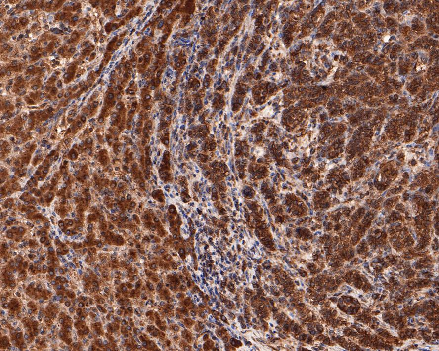 Immunohistochemical analysis of paraffin-embedded human liver carcinoma tissue with Rabbit anti-NLRP3 antibody (<a href="/products/ET1610-93" style="font-weight: bold;text-decoration: underline;">ET1610-93</a>) at 1/100 dilution.<br /><br />The section was pre-treated using heat mediated antigen retrieval with sodium citrate buffer (pH 6.0) for 2 minutes. The tissues were blocked in 1% BSA for 20 minutes at room temperature, washed with ddH<sub>2</sub>O and PBS, and then probed with the primary antibody (<a href="/products/ET1610-93" style="font-weight: bold;text-decoration: underline;">ET1610-93</a>) at 1/100 dilution for 1 hour at room temperature. The detection was performed using an HRP conjugated compact polymer system. DAB was used as the chromogen. Tissues were counterstained with hematoxylin and mounted with DPX.