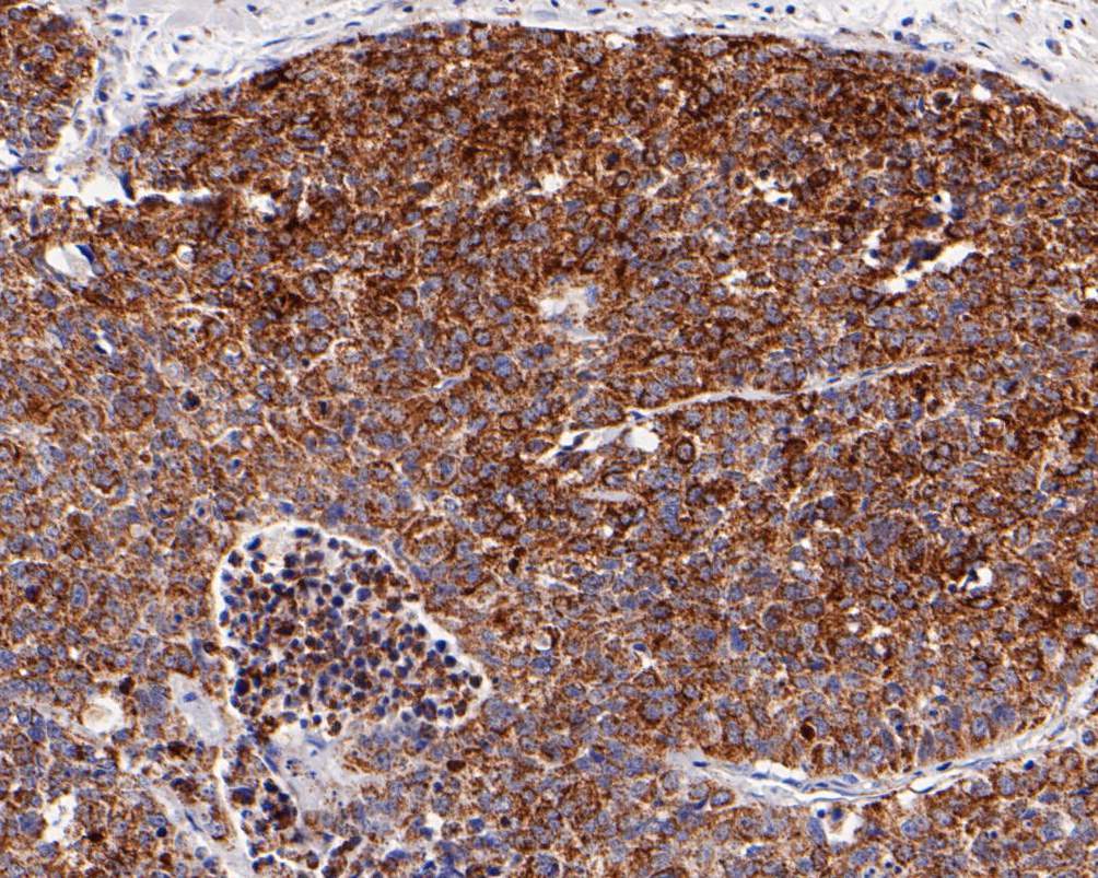 Immunohistochemical analysis of paraffin-embedded human lung carcinoma tissue using anti-NLRP3 antibody. The section was pre-treated using heat mediated antigen retrieval with Tris-EDTA buffer (pH 9.0) for 20 minutes.The tissues were blocked in 1% BSA for 30 minutes at room temperature, washed with ddH<sub>2</sub>O and PBS, and then probed with the primary antibody (<a href="/products/ET1610-93" style="font-weight: bold;text-decoration: underline;">ET1610-93</a>, 1/50) for 30 minutes at room temperature. The detection was performed using an HRP conjugated compact polymer system. DAB was used as the chromogen. Tissues were counterstained with hematoxylin and mounted with DPX.