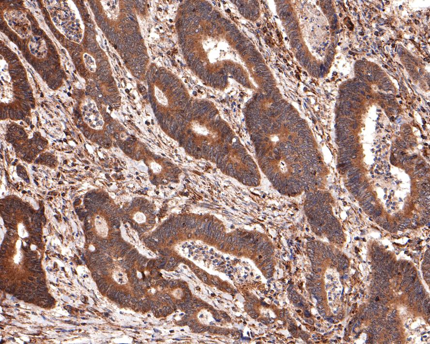Immunohistochemical analysis of paraffin-embedded human colon carcinoma tissue with Rabbit anti-NLRP3 antibody (<a href="/products/ET1610-93" style="font-weight: bold;text-decoration: underline;">ET1610-93</a>) at 1/400 dilution.<br /><br />The section was pre-treated using heat mediated antigen retrieval with sodium citrate buffer (pH 6.0) for 2 minutes. The tissues were blocked in 1% BSA for 20 minutes at room temperature, washed with ddH<sub>2</sub>O and PBS, and then probed with the primary antibody (<a href="/products/ET1610-93" style="font-weight: bold;text-decoration: underline;">ET1610-93</a>) at 1/400 dilution for 1 hour at room temperature. The detection was performed using an HRP conjugated compact polymer system. DAB was used as the chromogen. Tissues were counterstained with hematoxylin and mounted with DPX.