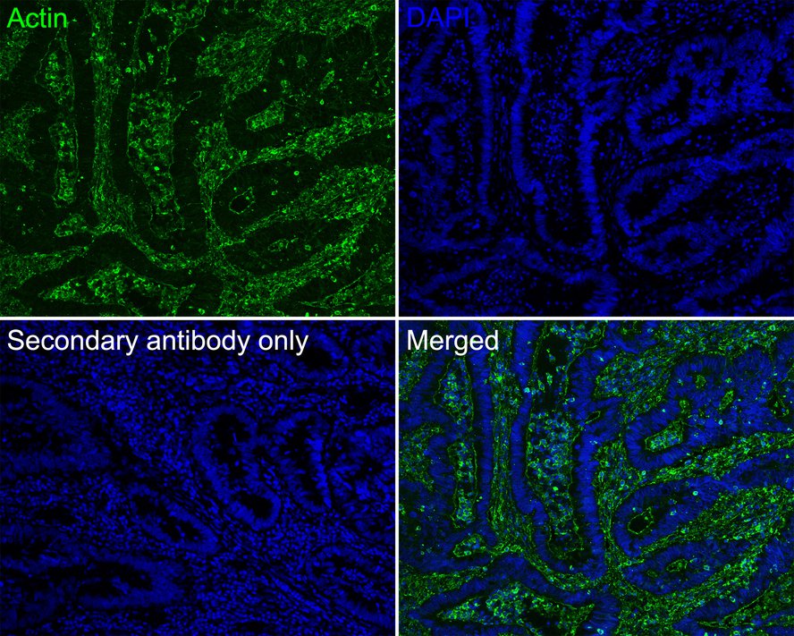 Immunofluorescence analysis of paraffin-embedded human colon carcinoma tissue labeling Actin with Rabbit anti-Actin antibody (<a href="/products/ET1701-80" style="font-weight: bold;text-decoration: underline;">ET1701-80</a>) at 1/100 dilution.<br /><br />The section was pre-treated using heat mediated antigen retrieval with Tris-EDTA buffer (pH 9.0) for 20 minutes. The tissues were blocked in 10% negative goat serum for 1 hour at room temperature, washed with PBS, and then probed with the primary antibody (<a href="/products/ET1701-80" style="font-weight: bold;text-decoration: underline;">ET1701-80</a>, green) at 1/100 dilution overnight at 4 ℃, washed with PBS.<br /><br />Goat Anti-Rabbit IgG H&L (iFluor&trade; 488, <a href="/products/HA1121" style="font-weight: bold;text-decoration: underline;">HA1121</a>) was used as the secondary antibody at 1/1,000 dilution. Nuclei were counterstained with DAPI (blue).