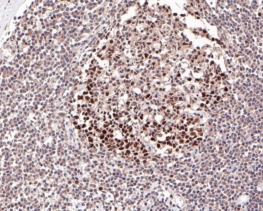 ICC staining of Dnmt1 in 293T cells (red). Formalin fixed cells were permeabilized with 0.1% Triton X-100 in TBS for 10 minutes at room temperature and blocked with 1% Blocker BSA for 15 minutes at room temperature. Cells were probed with the primary antibody (<a href="/products/ET1702-77" style="font-weight: bold;text-decoration: underline;">ET1702-77</a>, 1/50) for 1 hour at room temperature, washed with PBS. Alexa Fluor&reg;594 Goat anti-Rabbit IgG was used as the secondary antibody at 1/1,000 dilution. The nuclear counter stain is DAPI (blue).