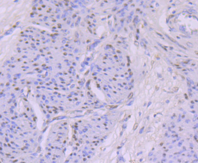 Immunohistochemical analysis of paraffin-embedded human cervix tissue with Rabbit anti-KAT8 antibody (<a href="/products/ET7108-23" style="font-weight: bold;text-decoration: underline;">ET7108-23</a>) at 1/50 dilution.<br /><br />The section was pre-treated using heat mediated antigen retrieval with sodium citrate buffer (pH 6.0) for 2 minutes. The tissues were blocked in 1% BSA for 20 minutes at room temperature, washed with ddH<sub>2</sub>O and PBS, and then probed with the primary antibody (<a href="/products/ET7108-23" style="font-weight: bold;text-decoration: underline;">ET7108-23</a>) at 1/50 dilution for 1 hour at room temperature. The detection was performed using an HRP conjugated compact polymer system. DAB was used as the chromogen. Tissues were counterstained with hematoxylin and mounted with DPX.
