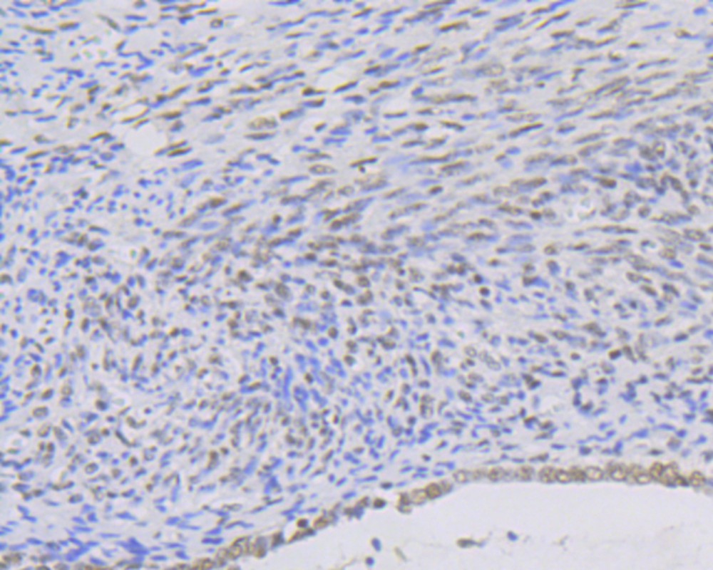 Immunohistochemical analysis of paraffin-embedded human cervix cancer tissue with Rabbit anti-KAT8 antibody (<a href="/products/ET7108-23" style="font-weight: bold;text-decoration: underline;">ET7108-23</a>) at 1/50 dilution.<br /><br />The section was pre-treated using heat mediated antigen retrieval with sodium citrate buffer (pH 6.0) for 2 minutes. The tissues were blocked in 1% BSA for 20 minutes at room temperature, washed with ddH<sub>2</sub>O and PBS, and then probed with the primary antibody (<a href="/products/ET7108-23" style="font-weight: bold;text-decoration: underline;">ET7108-23</a>) at 1/50 dilution for 1 hour at room temperature. The detection was performed using an HRP conjugated compact polymer system. DAB was used as the chromogen. Tissues were counterstained with hematoxylin and mounted with DPX.