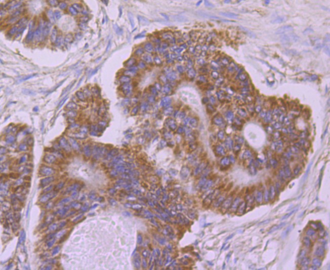 Immunohistochemical analysis of paraffin-embedded human colon carcinoma tissue with Rabbit anti-UQCRFS1 antibody (<a href="/products/ET7108-28" style="font-weight: bold;text-decoration: underline;">ET7108-28</a>) at 1/50 dilution.<br /><br />The section was pre-treated using heat mediated antigen retrieval with Tris-EDTA buffer (pH 9.0) for 20 minutes. The tissues were blocked in 1% BSA for 20 minutes at room temperature, washed with ddH<sub>2</sub>O and PBS, and then probed with the primary antibody (<a href="/products/ET7108-28" style="font-weight: bold;text-decoration: underline;">ET7108-28</a>) at 1/50 dilution for 0.5 hour at room temperature. The detection was performed using an HRP conjugated compact polymer system. DAB was used as the chromogen. Tissues were counterstained with hematoxylin and mounted with DPX.
