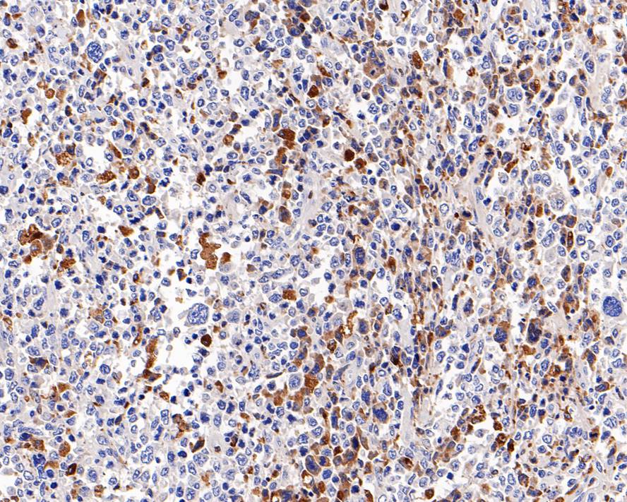 Immunohistochemical analysis of paraffin-embedded human diffuse large B-cell lymphoma tissue with Mouse anti-CD68 antibody (<a href="/products/HA601115" style="font-weight: bold;text-decoration: underline;">HA601115</a>) at 1/4,000 dilution.<br /><br />The section was pre-treated using heat mediated antigen retrieval with Tris-EDTA buffer (pH 9.0) for 20 minutes. The tissues were blocked in 1% BSA for 20 minutes at room temperature, washed with ddH<sub>2</sub>O and PBS, and then probed with the primary antibody (<a href="/products/HA601115" style="font-weight: bold;text-decoration: underline;">HA601115</a>) at 1/4,000 dilution for 1 hour at room temperature. The detection was performed using an HRP conjugated compact polymer system. DAB was used as the chromogen. Tissues were counterstained with hematoxylin and mounted with DPX.