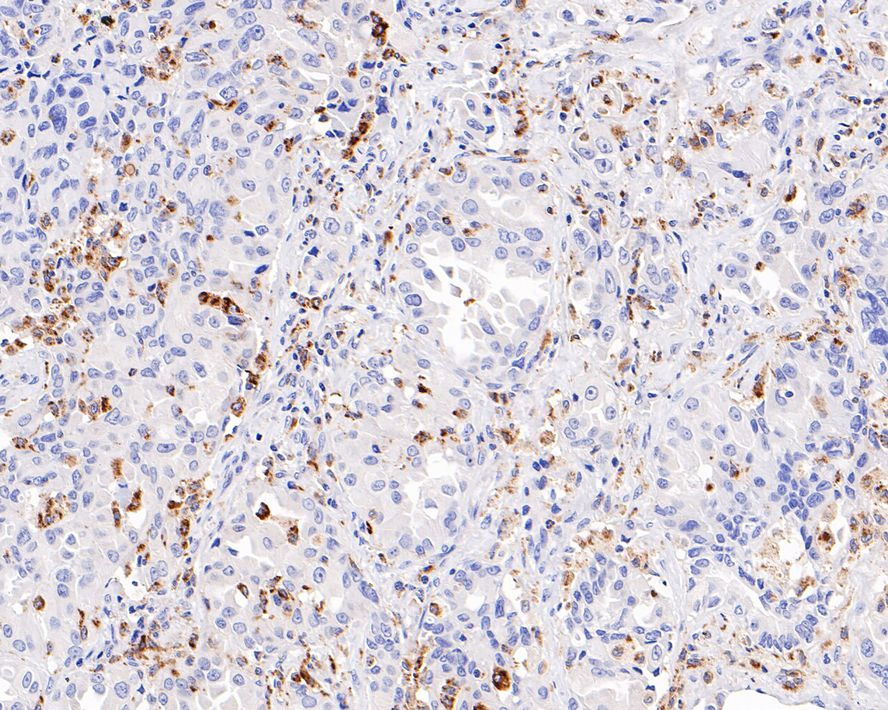 Immunohistochemical analysis of paraffin-embedded human lung adenocarcinoma tissue (Negative control) with Mouse anti-CD68 antibody (<a href="/products/HA601115" style="font-weight: bold;text-decoration: underline;">HA601115</a>) at 1/4,000 dilution.<br /><br />The section was pre-treated using heat mediated antigen retrieval with Tris-EDTA buffer (pH 9.0) for 20 minutes. The tissues were blocked in 1% BSA for 20 minutes at room temperature, washed with ddH<sub>2</sub>O and PBS, and then probed with the primary antibody (<a href="/products/HA601115" style="font-weight: bold;text-decoration: underline;">HA601115</a>) at 1/4,000 dilution for 1 hour at room temperature. The detection was performed using an HRP conjugated compact polymer system. DAB was used as the chromogen. Tissues were counterstained with hematoxylin and mounted with DPX.