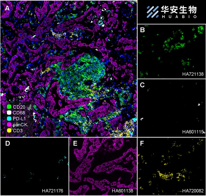 Fluorescence multiplex immunohistochemical analysis of the human non-small cell lung cancer (Formalin/PFA-fixed paraffin-embedded sections). Panel A: the merged image of anti-CD20 (<a href="/products/HA721138" style="font-weight: bold;text-decoration: underline;">HA721138</a>, green), anti-CD68 (<a href="/products/HA601115" style="font-weight: bold;text-decoration: underline;">HA601115</a>, gray), anti-PD-L1 (<a href="/products/HA721176" style="font-weight: bold;text-decoration: underline;">HA721176</a>, cyan), anti-panCK (<a href="/products/HA601138" style="font-weight: bold;text-decoration: underline;">HA601138</a>, magenta) and anti-CD3 (<a href="/products/HA720082" style="font-weight: bold;text-decoration: underline;">HA720082</a>, yellow) on human non-small cell lung cancer. Panel B: anti- CD20 stained on B cells. Panel C: anti-CD68 stained on macrophage M1 and macrophage M2. Panel D: anti-PD-L1 stained on dendritic cells and macrophages cells. Panel E: anti-panCK stained on cancer cells. Panel F: anti-CD3 stained on T cells. HRP Conjugated UltraPolymer Goat Polyclonal Antibody HA1119/HA1120 was used as a secondary antibody. The immunostaining was performed with the Sequential Immuno-staining Kit (IRISKit&trade;MH010101, www.luminiris.cn). The section was incubated in five rounds of staining: in the order of <a href="/products/HA721138" style="font-weight: bold;text-decoration: underline;">HA721138</a> (1/1,500 dilution), <a href="/products/HA601115" style="font-weight: bold;text-decoration: underline;">HA601115</a> (1/2,000 dilution), <a href="/products/HA721176" style="font-weight: bold;text-decoration: underline;">HA721176</a> (1/1,000 dilution), <a href="/products/HA601138" style="font-weight: bold;text-decoration: underline;">HA601138</a> (1/3,000 dilution), and <a href="/products/HA720082" style="font-weight: bold;text-decoration: underline;">HA720082</a> (1/500 dilution) for 20 mins at room temperature. Each round was followed by a separate fluorescent tyramide signal amplification system. Heat mediated antigen retrieval with Tris-EDTA buffer (pH 9.0) for 30 mins at 95C. DAPI (blue) was used as a nuclear counter stain. Image acquisition was performed with Olympus VS200 Slide Scanner.