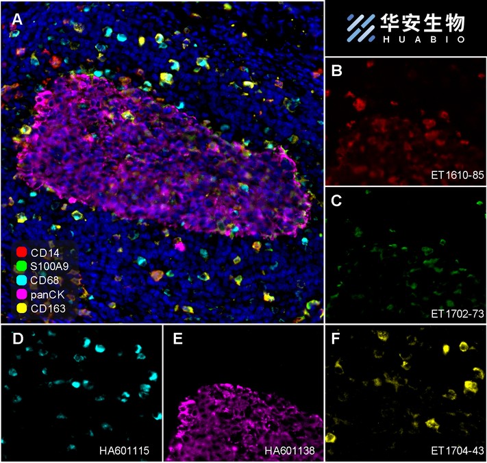 Fluorescence multiplex immunohistochemical analysis of the human cervical cancer (Formalin/PFA-fixed paraffin-embedded sections). Panel A: the merged image of anti-CD14 (<a href="/products/ET1610-85" style="font-weight: bold;text-decoration: underline;">ET1610-85</a>, red), anti-S100A9 (<a href="/products/ET1702-73" style="font-weight: bold;text-decoration: underline;">ET1702-73</a>, green), anti-CD68 (<a href="/products/HA601115" style="font-weight: bold;text-decoration: underline;">HA601115</a>, cyan), anti-panCK (<a href="/products/HA601138" style="font-weight: bold;text-decoration: underline;">HA601138</a>, magenta) and anti-CD163 (<a href="/products/ET1704-43" style="font-weight: bold;text-decoration: underline;">ET1704-43</a>, yellow) on human cervical cancer. Panel B: anti- CD14 stained on monocyte and MDSCs. Panel C: anti-S100A9 stained on MDSCs. Panel D: anti-CD68 stained on macrophage M1 and macrophage M2. Panel E: anti-panCK stained on tumor cells. Panel F: anti-CD163 stained on macrophage M2. HRP Conjugated UltraPolymer Goat Polyclonal Antibody HA1119/HA1120 was used as a secondary antibody. The immunostaining was performed with the Sequential Immuno-staining Kit (IRISKit&trade;MH010101, www.luminiris.cn). The section was incubated in five rounds of staining: in the order of <a href="/products/ET1610-85" style="font-weight: bold;text-decoration: underline;">ET1610-85</a> (1/1,000 dilution), <a href="/products/ET1702-73" style="font-weight: bold;text-decoration: underline;">ET1702-73</a> (1/1,000 dilution), <a href="/products/HA601115" style="font-weight: bold;text-decoration: underline;">HA601115</a> (1/2,000 dilution), <a href="/products/HA601138" style="font-weight: bold;text-decoration: underline;">HA601138</a> (1/3,000 dilution), and <a href="/products/ET1704-43" style="font-weight: bold;text-decoration: underline;">ET1704-43</a> (1/2,000 dilution) for 20 mins at room temperature. Each round was followed by a separate fluorescent tyramide signal amplification system. Heat mediated antigen retrieval with Tris-EDTA buffer (pH 9.0) for 30 mins at 95C. DAPI (blue) was used as a nuclear counter stain. Image acquisition was performed with Olympus VS200 Slide Scanner.