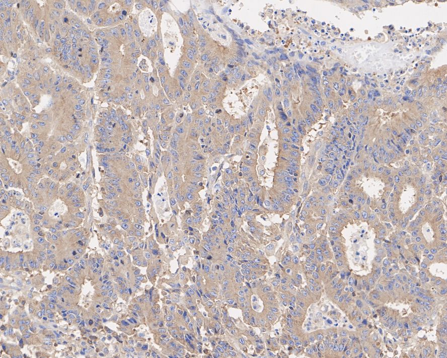 Immunohistochemical analysis of paraffin-embedded human colon cancer tissue with Mouse anti-beta Tubulin antibody (<a href="/products/HA601187" style="font-weight: bold;text-decoration: underline;">HA601187</a>) at 1/10,000 dilution.<br /><br />The section was pre-treated using heat mediated antigen retrieval with Tris-EDTA buffer (pH 9.0) for 20 minutes. The tissues were blocked in 1% BSA for 20 minutes at room temperature, washed with ddH<sub>2</sub>O and PBS, and then probed with the primary antibody (<a href="/products/HA601187" style="font-weight: bold;text-decoration: underline;">HA601187</a>) at 1/10,000 dilution for 1 hour at room temperature. The detection was performed using an HRP conjugated compact polymer system. DAB was used as the chromogen. Tissues were counterstained with hematoxylin and mounted with DPX.