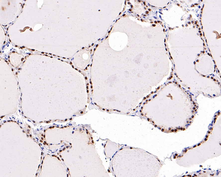 Immunohistochemical analysis of paraffin-embedded human thyroid carcinoma tissue with Rabbit anti-PAX8 antibody (<a href="/products/HA720112" style="font-weight: bold;text-decoration: underline;">HA720112</a>) at 1/5,000 dilution.<br /><br />The section was pre-treated using heat mediated antigen retrieval with sodium citrate buffer (pH 6.0) for 2 minutes. The tissues were blocked in 1% BSA for 20 minutes at room temperature, washed with ddH<sub>2</sub>O and PBS, and then probed with the primary antibody (<a href="/products/HA720112" style="font-weight: bold;text-decoration: underline;">HA720112</a>) at 1/5,000 dilution for 1 hour at room temperature. The detection was performed using an HRP conjugated compact polymer system. DAB was used as the chromogen. Tissues were counterstained with hematoxylin and mounted with DPX.