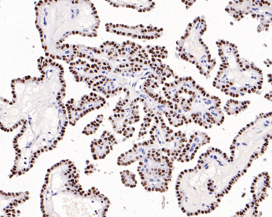 Immunohistochemical analysis of paraffin-embedded human renal clear cell carcinoma tissue with Rabbit anti-PAX8 antibody (<a href="/products/HA720112" style="font-weight: bold;text-decoration: underline;">HA720112</a>) at 1/500 dilution.<br /><br />The section was pre-treated using heat mediated antigen retrieval with sodium citrate buffer (pH 6.0) for 2 minutes. The tissues were blocked in 1% BSA for 20 minutes at room temperature, washed with ddH<sub>2</sub>O and PBS, and then probed with the primary antibody (<a href="/products/HA720112" style="font-weight: bold;text-decoration: underline;">HA720112</a>) at 1/500 dilution for 1 hour at room temperature. The detection was performed using an HRP conjugated compact polymer system. DAB was used as the chromogen. Tissues were counterstained with hematoxylin and mounted with DPX.