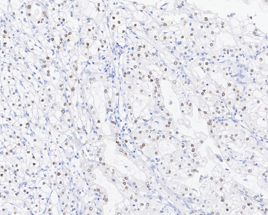 Immunocytochemistry analysis of SKOV-3 cells labeling PAX8 with Rabbit anti-PAX8 antibody (<a href="/products/HA720112" style="font-weight: bold;text-decoration: underline;">HA720112</a>) at 1/100 dilution.<br /><br />Cells were fixed in 4% paraformaldehyde for 10 minutes at 37 ℃, permeabilized with 0.05% Triton X-100 in PBS for 20 minutes, and then blocked with 2% negative goat serum for 30 minutes at room temperature. Cells were then incubated with Rabbit anti-PAX8 antibody (<a href="/products/HA720112" style="font-weight: bold;text-decoration: underline;">HA720112</a>) at 1/100 dilution in 2% negative goat serum overnight at 4 ℃. Goat Anti-Rabbit IgG H&L (iFluor&trade; 488, <a href="/products/HA1121" style="font-weight: bold;text-decoration: underline;">HA1121</a>) was used as the secondary antibody at 1/1,000 dilution. PBS instead of the primary antibody was used as the secondary antibody only control. Nuclear DNA was labelled in blue with DAPI.