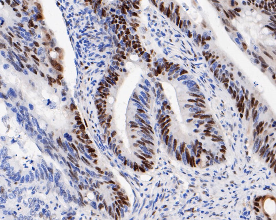 Immunohistochemical analysis of paraffin-embedded human colon carcinoma tissue using anti-Cyclin D1 antibody. The section was pre-treated using heat mediated antigen retrieval with sodium citrate buffer (pH 6.0) for 2 minutes. The tissues were blocked in 5% BSA for 30 minutes at room temperature, washed with ddH<sub>2</sub>O and PBS, and then probed with the primary antibody (<a href="/products/ET1601-31" style="font-weight: bold;text-decoration: underline;">ET1601-31</a>, 1/200) for 30 minutes at room temperature. The detection was performed using an HRP conjugated compact polymer system. DAB was used as the chromogen. Tissues were counterstained with hematoxylin and mounted with DPX.