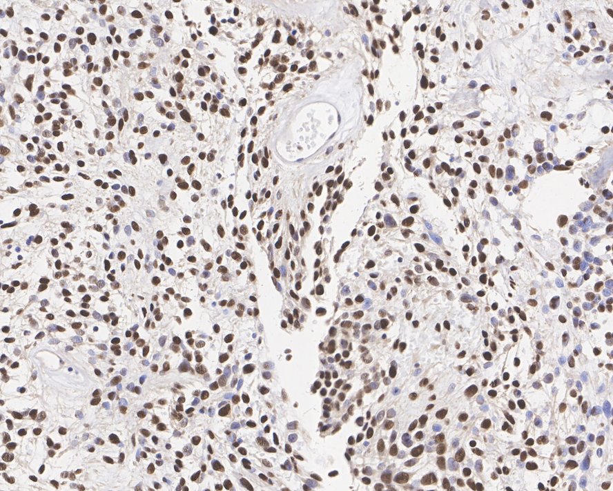Immunohistochemical analysis of paraffin-embedded human solitary fibrous tumor tissue with Rabbit anti-STAT6 antibody (<a href="/products/ET1605-49" style="font-weight: bold;text-decoration: underline;">ET1605-49</a>) at 1/1,000 dilution.<br /><br />The section was pre-treated using heat mediated antigen retrieval with sodium citrate buffer (pH 6.0) for 2 minutes. The tissues were blocked in 1% BSA for 20 minutes at room temperature, washed with ddH<sub>2</sub>O and PBS, and then probed with the primary antibody (<a href="/products/ET1605-49" style="font-weight: bold;text-decoration: underline;">ET1605-49</a>) at 1/1,000 dilution for 1 hour at room temperature. The detection was performed using an HRP conjugated compact polymer system. DAB was used as the chromogen. Tissues were counterstained with hematoxylin and mounted with DPX.
