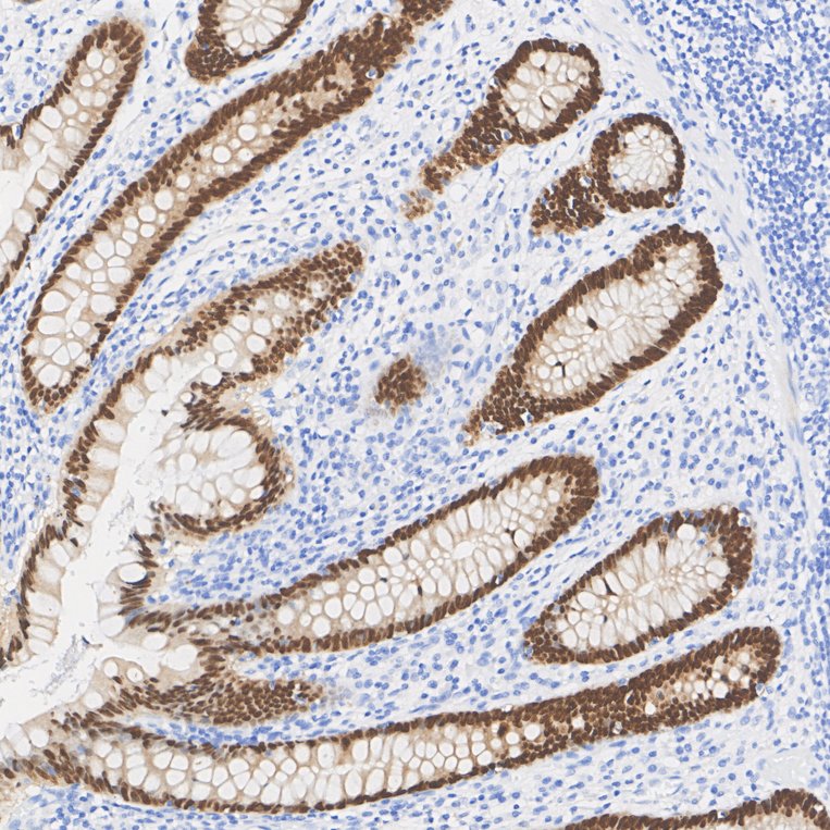 Immunohistochemical analysis of paraffin-embedded human appendix tissue with Rabbit anti-CDX2 antibody (<a href="/products/ET1605-4" style="font-weight: bold;text-decoration: underline;">ET1605-4</a>) at 1/5,000 dilution.<br /><br />The section was pre-treated using heat mediated antigen retrieval with sodium citrate buffer (pH 6.0) for 2 minutes. The tissues were blocked in 1% BSA for 20 minutes at room temperature, washed with ddH<sub>2</sub>O and PBS, and then probed with the primary antibody (<a href="/products/ET1605-4" style="font-weight: bold;text-decoration: underline;">ET1605-4</a>) at 1/5,000 dilution for 1 hour at room temperature. The detection was performed using an HRP conjugated compact polymer system. DAB was used as the chromogen. Tissues were counterstained with hematoxylin and mounted with DPX.