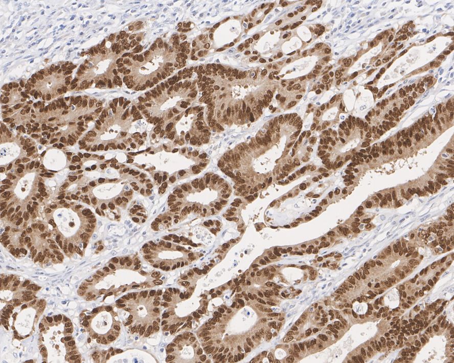 Immunohistochemical analysis of paraffin-embedded Human stomach cancer tissue with Rabbit anti-CDX2 antibody (<a href="/products/ET1605-4" style="font-weight: bold;text-decoration: underline;">ET1605-4</a>) at 1/500 dilution.<br /><br />The section was pre-treated using heat mediated antigen retrieval with sodium citrate buffer (pH 6.0) for 2 minutes. The tissues were blocked in 1% BSA for 20 minutes at room temperature, washed with ddH<sub>2</sub>O and PBS, and then probed with the primary antibody (<a href="/products/ET1605-4" style="font-weight: bold;text-decoration: underline;">ET1605-4</a>) at 1/500 dilution for 1 hour at room temperature. The detection was performed using an HRP conjugated compact polymer system. DAB was used as the chromogen. Tissues were counterstained with hematoxylin and mounted with DPX.