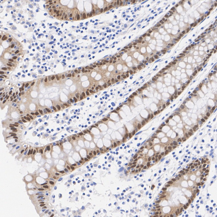 Immunohistochemical analysis of paraffin-embedded human colon cancer tissue with Rabbit anti-CDX2 antibody (<a href="/products/ET1605-4" style="font-weight: bold;text-decoration: underline;">ET1605-4</a>) at 1/5,000 dilution.<br /><br />The section was pre-treated using heat mediated antigen retrieval with sodium citrate buffer (pH 6.0) for 2 minutes. The tissues were blocked in 1% BSA for 20 minutes at room temperature, washed with ddH<sub>2</sub>O and PBS, and then probed with the primary antibody (<a href="/products/ET1605-4" style="font-weight: bold;text-decoration: underline;">ET1605-4</a>) at 1/5,000 dilution for 1 hour at room temperature. The detection was performed using an HRP conjugated compact polymer system. DAB was used as the chromogen. Tissues were counterstained with hematoxylin and mounted with DPX.
