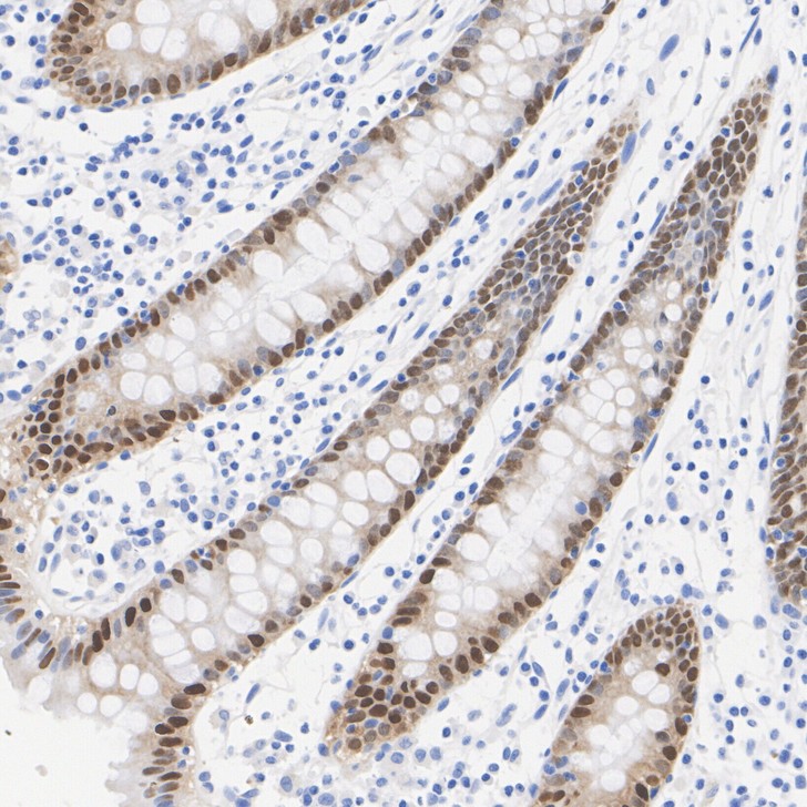 Immunohistochemical analysis of paraffin-embedded human colon tissue with Rabbit anti-CDX2 antibody (<a href="/products/ET1605-4" style="font-weight: bold;text-decoration: underline;">ET1605-4</a>) at 1/20,000 dilution.<br /><br />The section was pre-treated using heat mediated antigen retrieval with sodium citrate buffer (pH 6.0) for 2 minutes. The tissues were blocked in 1% BSA for 20 minutes at room temperature, washed with ddH<sub>2</sub>O and PBS, and then probed with the primary antibody (<a href="/products/ET1605-4" style="font-weight: bold;text-decoration: underline;">ET1605-4</a>) at 1/20,000 dilution for 1 hour at room temperature. The detection was performed using an HRP conjugated compact polymer system. DAB was used as the chromogen. Tissues were counterstained with hematoxylin and mounted with DPX.