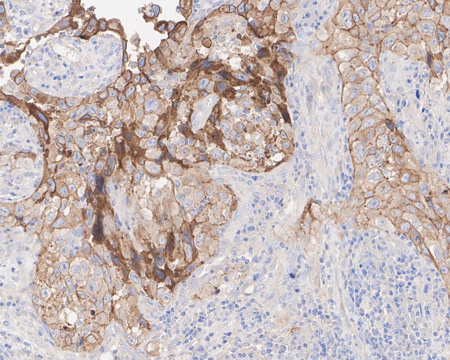 Immunohistochemical analysis of paraffin-embedded human lung carcinoma tissue with Rabbit anti-E-Cadherin antibody (<a href=