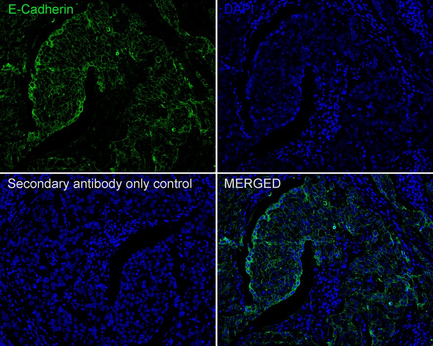 Application: IF-tissue<br /><br />Species: Human <br /><br />Site: Breast cancer<br /><br />Sample: Paraffin-embedded section<br /><br />Antibody concentration: 1/200