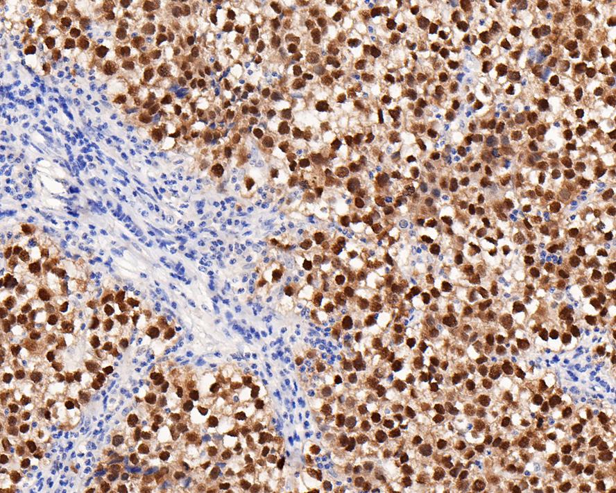 Immunohistochemical analysis of paraffin-embedded human seminoma tissue with Rabbit anti-Oct4 antibody (<a href=