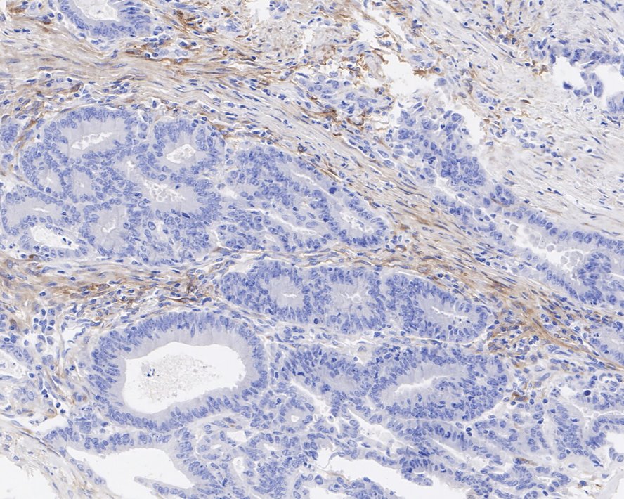 Immunohistochemical analysis of paraffin-embedded human colon cancer tissue with Rabbit anti-PDGFR alpha antibody (<a href="/products/ET1702-49" style="font-weight: bold;text-decoration: underline;">ET1702-49</a>) at 1/500 dilution.<br /><br />The section was pre-treated using heat mediated antigen retrieval with Tris-EDTA buffer (pH 9.0) for 20 minutes. The tissues were blocked in 1% BSA for 20 minutes at room temperature, washed with ddH<sub>2</sub>O and PBS, and then probed with the primary antibody (<a href="/products/ET1702-49" style="font-weight: bold;text-decoration: underline;">ET1702-49</a>) at 1/500 dilution for 1 hour at room temperature. The detection was performed using an HRP conjugated compact polymer system. DAB was used as the chromogen. Tissues were counterstained with hematoxylin and mounted with DPX.