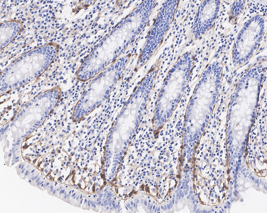 Immunohistochemical analysis of paraffin-embedded human colon tissue with Rabbit anti-PDGFR alpha antibody (<a href="/products/ET1702-49" style="font-weight: bold;text-decoration: underline;">ET1702-49</a>) at 1/500 dilution.<br /><br />The section was pre-treated using heat mediated antigen retrieval with Tris-EDTA buffer (pH 9.0) for 20 minutes. The tissues were blocked in 1% BSA for 20 minutes at room temperature, washed with ddH<sub>2</sub>O and PBS, and then probed with the primary antibody (<a href="/products/ET1702-49" style="font-weight: bold;text-decoration: underline;">ET1702-49</a>) at 1/500 dilution for 1 hour at room temperature. The detection was performed using an HRP conjugated compact polymer system. DAB was used as the chromogen. Tissues were counterstained with hematoxylin and mounted with DPX.
