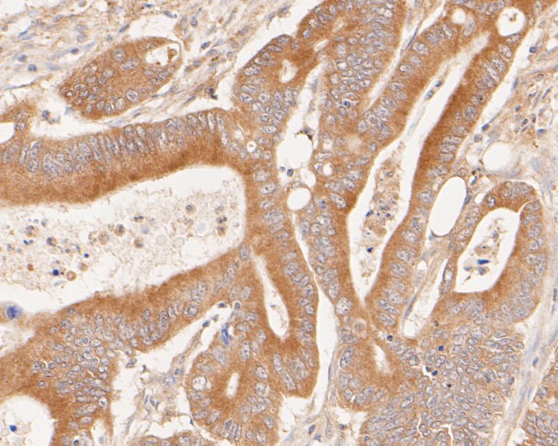 Immunohistochemical analysis of paraffin-embedded human colon carcinoma tissue using anti-Phospho-Met (Y1349) antibody. The section was pre-treated using heat mediated antigen retrieval with Tris-EDTA buffer (pH 8.0-8.4) for 20 minutes.The tissues were blocked in 5% BSA for 30 minutes at room temperature, washed with ddH<sub>2</sub>O and PBS, and then probed with the primary antibody (<a href=