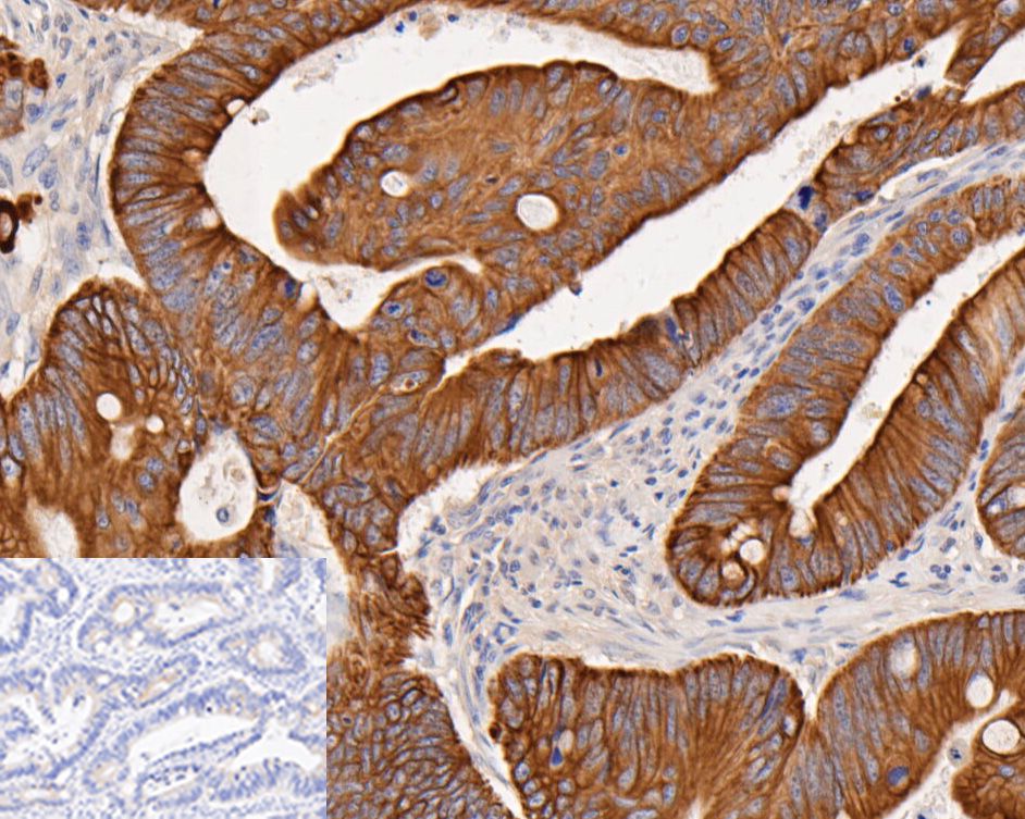 Immunohistochemical analysis of paraffin-embedded human Colorectal cancer tissue using rabbit anti-Cytokeratin 18 antibody.<br /><br />The section was pre-treated using heat mediated antigen retrieval with Tris-EDTA buffer (pH 8.0-8.4) for 20 minutes.The tissues were blocked in 5% BSA for 30 minutes at room temperature, washed with ddH<sub>2</sub>O and PBS, and then probed with the primary antibody (<a href=