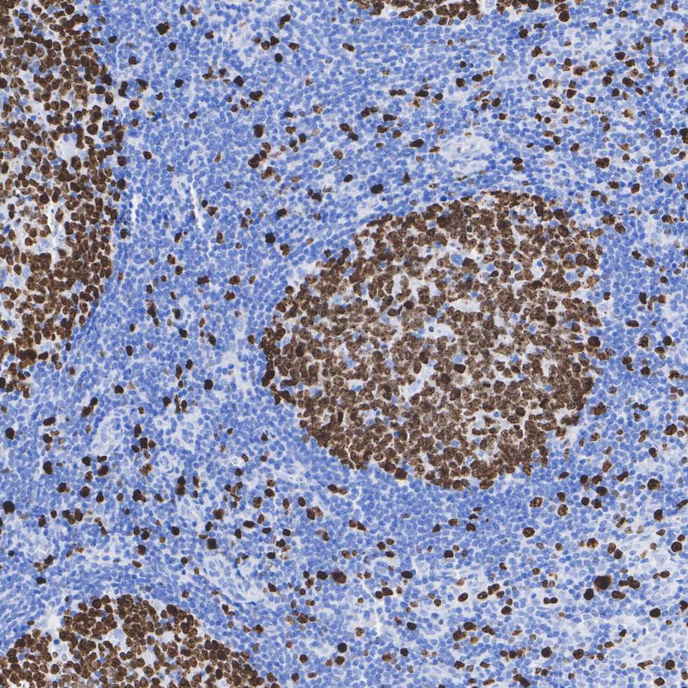 Immunohistochemical analysis of paraffin-embedded human tonsil tissue with Rabbit anti-Ki67 antibody (<a href="/products/HA721115" style="font-weight: bold;text-decoration: underline;">HA721115</a>) at 1/15,000 dilution.<br /><br />The section was pre-treated using heat mediated antigen retrieval with sodium citrate buffer (pH 6.0) for 2 minutes. The tissues were blocked in 1% BSA for 20 minutes at room temperature, washed with ddH<sub>2</sub>O and PBS, and then probed with the primary antibody (<a href="/products/HA721115" style="font-weight: bold;text-decoration: underline;">HA721115</a>) at 1/15,000 dilution for 1 hour at room temperature. The detection was performed using an HRP conjugated compact polymer system. DAB was used as the chromogen. Tissues were counterstained with hematoxylin and mounted with DPX.