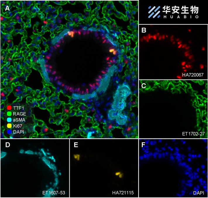 Fluorescence multiplex immunohistochemical analysis of the human gastric cancer (Formalin/PFA-fixed paraffin-embedded sections). Panel A: the merged image of anti-Ki67 (<a href="/products/HA721115" style="font-weight: bold;text-decoration: underline;">HA721115</a>, red), anti-CD31 (<a href="/products/M1511-8" style="font-weight: bold;text-decoration: underline;">M1511-8</a>, green), anti-CD3 (<a href="/products/HA720082" style="font-weight: bold;text-decoration: underline;">HA720082</a>, cyan), anti-panCK (<a href="/products/HA601138" style="font-weight: bold;text-decoration: underline;">HA601138</a>, magenta) and anti-αSMA (<a href="/products/ET1607-53" style="font-weight: bold;text-decoration: underline;">ET1607-53</a>, yellow) on human gastric cancer. Panel B: anti- Ki67 stained on cells in G1, S, G2 and M phases of cell cycle. Panel C: anti-CD31 stained on the endothelial cells. Panel D: anti-CD3 stained on T cells. Panel E: anti-panCK stained on cancer cells. Panel F: anti-αSMA stained on cancer-associated fibroblasts and smooth muscle cells. HRP Conjugated UltraPolymer Goat Polyclonal Antibody HA1119/HA1120 was used as a secondary antibody. The immunostaining was performed with the Sequential Immuno-staining Kit (IRISKit™MH010101, www.luminiris.cn). The section was incubated in five rounds of staining: in the order of <a href="/products/HA721115" style="font-weight: bold;text-decoration: underline;">HA721115</a> (1/2,000 dilution), <a href="/products/M1511-8" style="font-weight: bold;text-decoration: underline;">M1511-8</a> (1/1,000 dilution), <a href="/products/HA720082" style="font-weight: bold;text-decoration: underline;">HA720082</a> (1/500 dilution), <a href="/products/HA601138" style="font-weight: bold;text-decoration: underline;">HA601138</a> (1/3,000 dilution), and <a href="/products/ET1607-53" style="font-weight: bold;text-decoration: underline;">ET1607-53</a> (1/2,000 dilution) for 20 mins at room temperature. Each round was followed by a separate fluorescent tyramide signal amplification system. Heat mediated antigen retrieval with Tris-EDTA buffer (pH 9.0) for 30 mins at 95℃. DAPI (blue) was used as a nuclear counter stain. Image acquisition was performed with Olympus VS200 Slide Scanner.